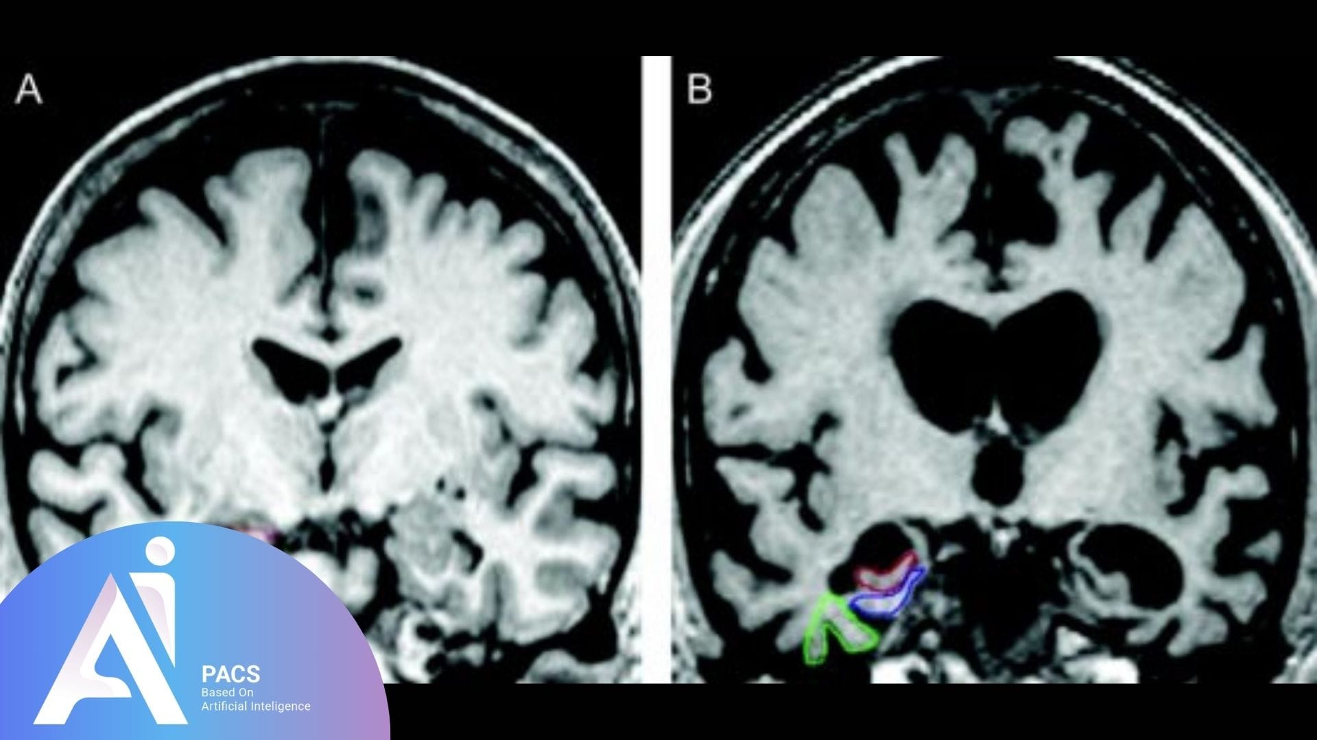 Brain MRI showing coronal slices of the brain, with outlined regions highlighting areas of interest for Alzheimer's disease research and diagnosis.