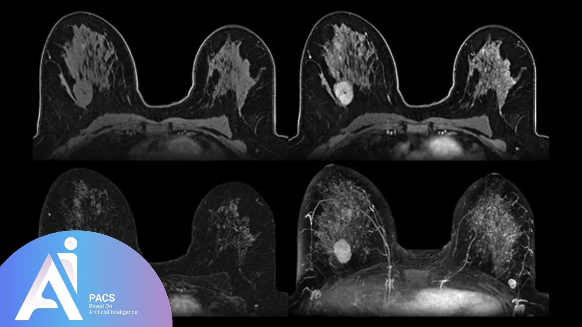Breast MRI images showing cross-sectional views of both breasts. The scans highlight different tissue patterns and areas of enhancement, commonly used to evaluate abnormalities such as masses, lesions, or asymmetries for diagnostic purposes