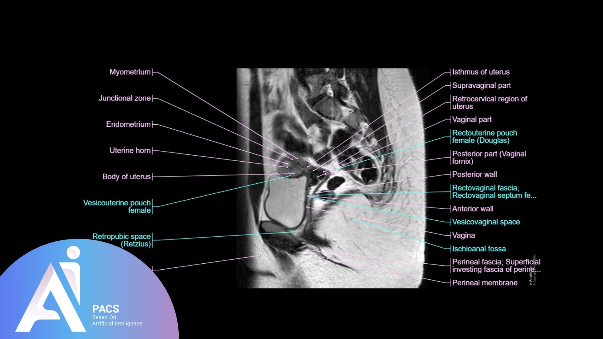 Female pelvic MRI sagittal view