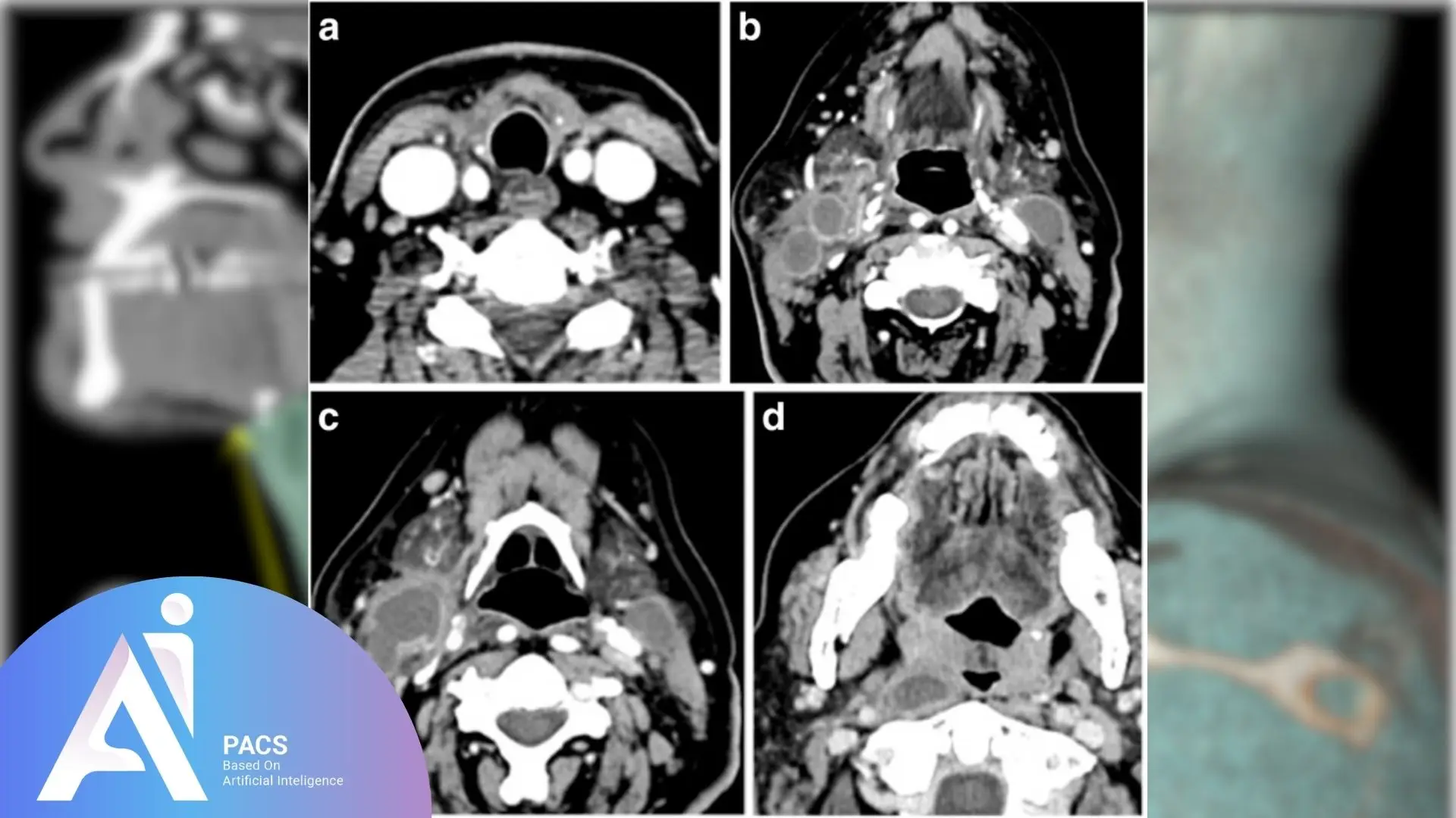 How to read ct scan of metastatic neck nodules in AI-PACS