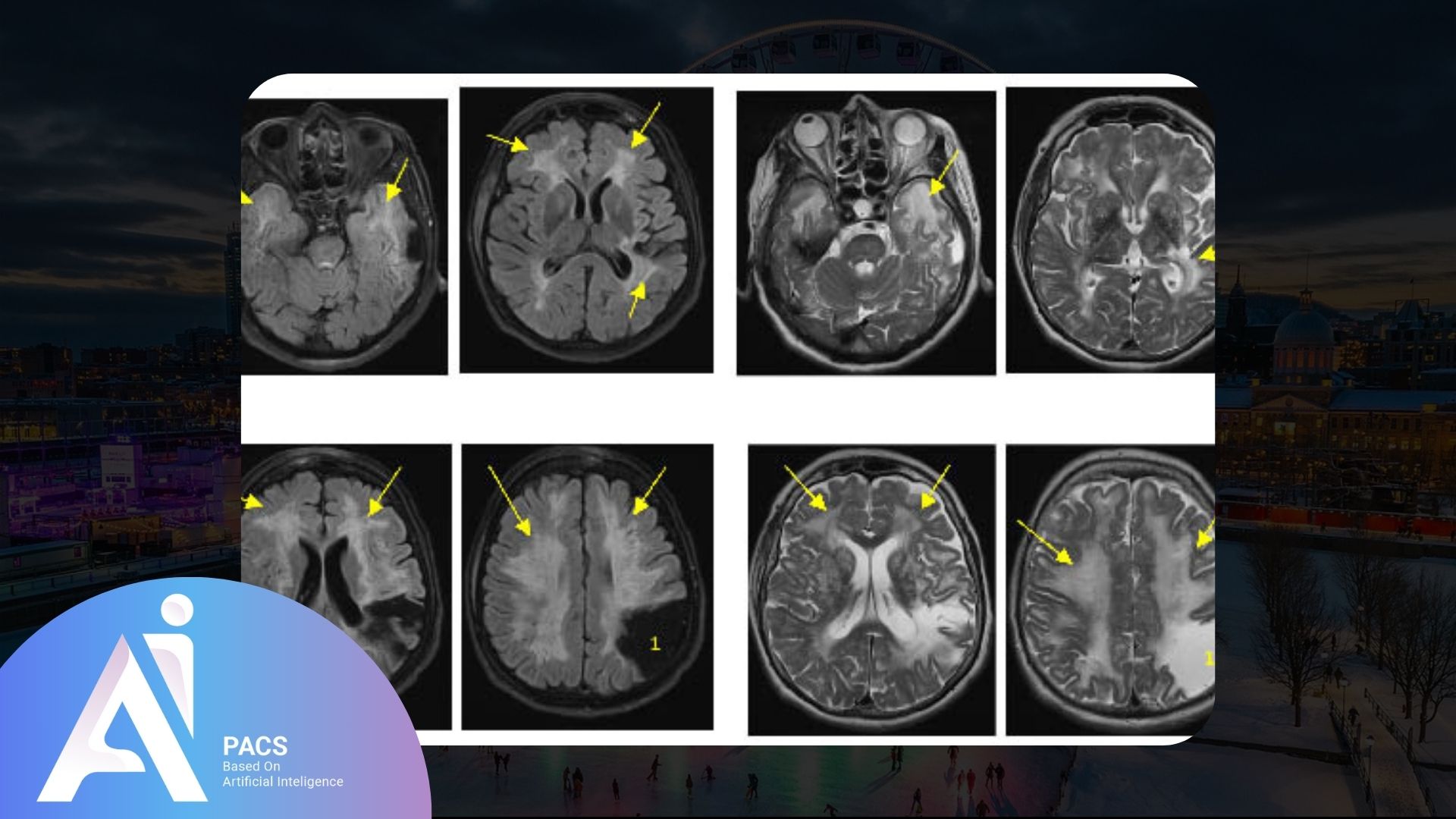 Imagerie IRM cérébrale avec des flèches jaunes indiquant des zones d'intérêt dans différentes coupes transversales du cerveau.