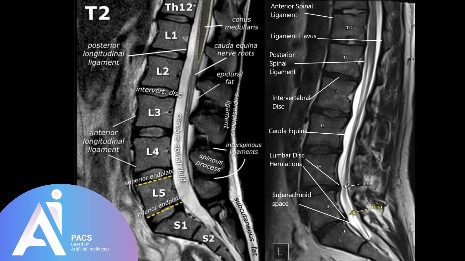 Annotated sagittal T2-weighted MRI of lumbar spine demonstrating normal anatomical landmarks.