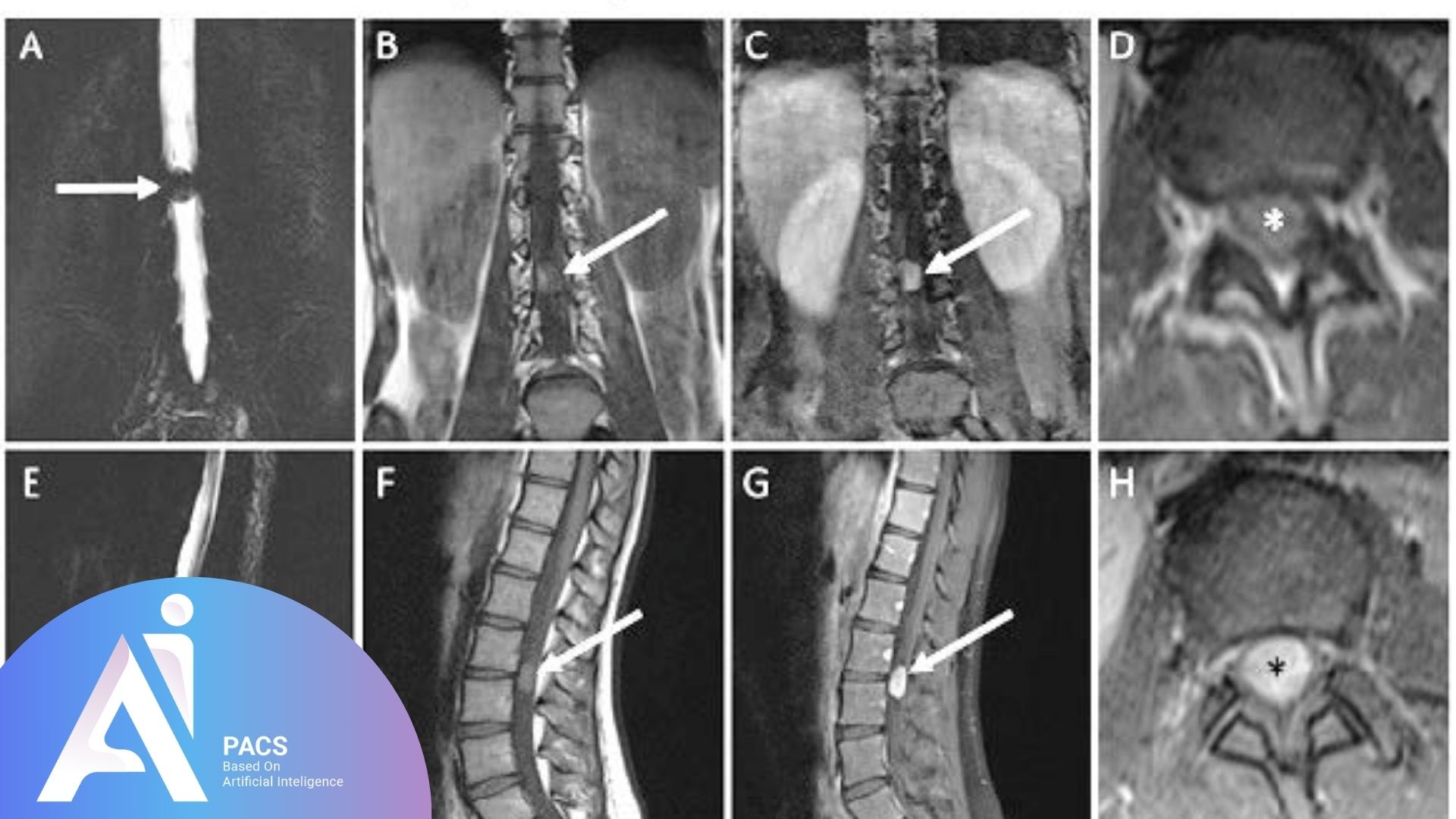 Multiple MRI views of the lumbar spine demonstrating spinal pathologies.
