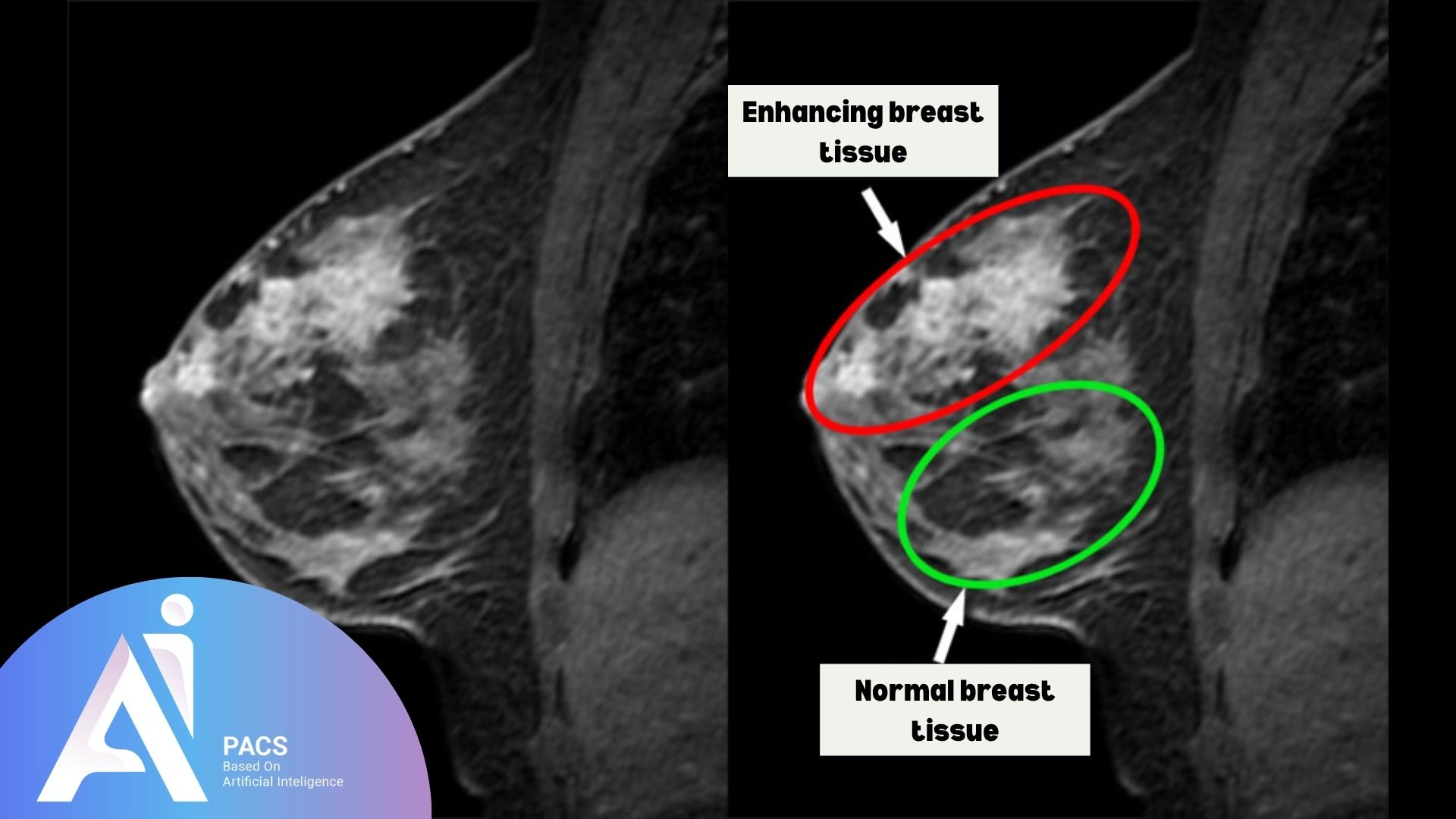 Side-by-side sagittal MRI views of a breast showing areas of enhancing tissue versus normal tissue. The right image includes labeled annotations_ a red circle highlights enhancing breast tissue, which may require further evaluation, while
