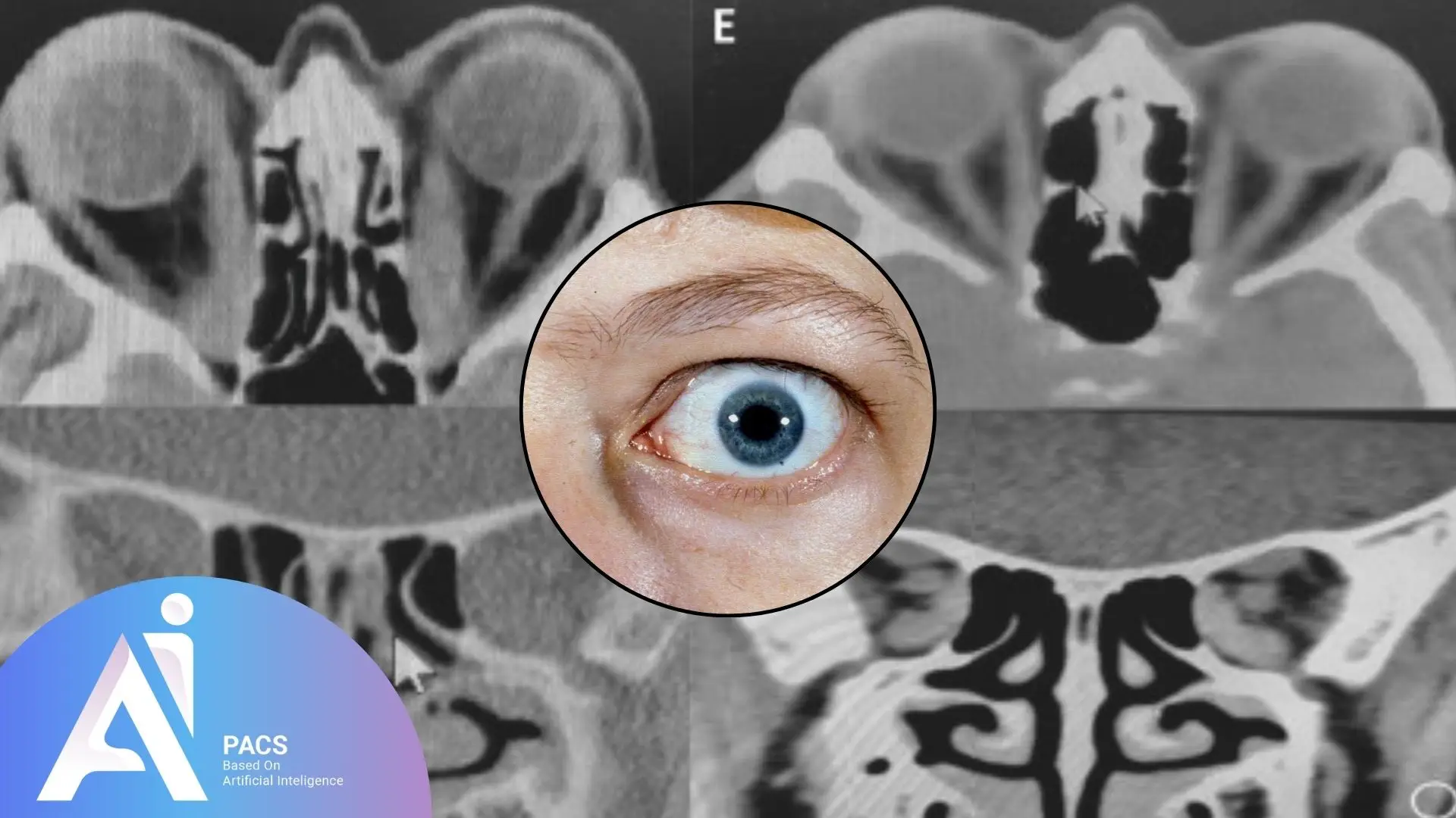 Thyroid Eye Disease (Ophthalmopathy) shows in MRI of a patient