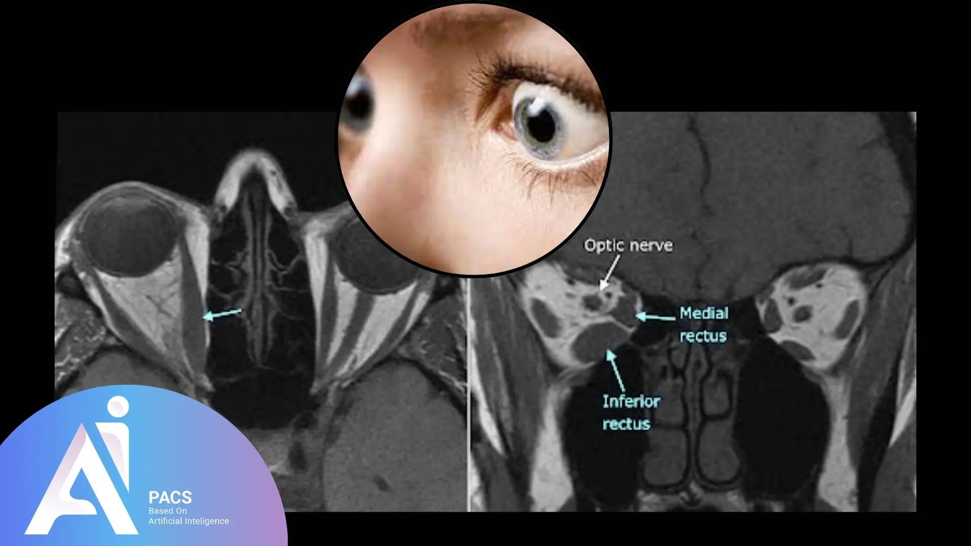 Thyroid Eye Disease shows in MRI Imaging