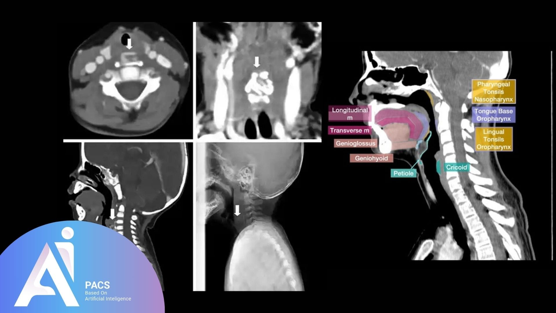 how to read a neck CT scan in AI-PACS