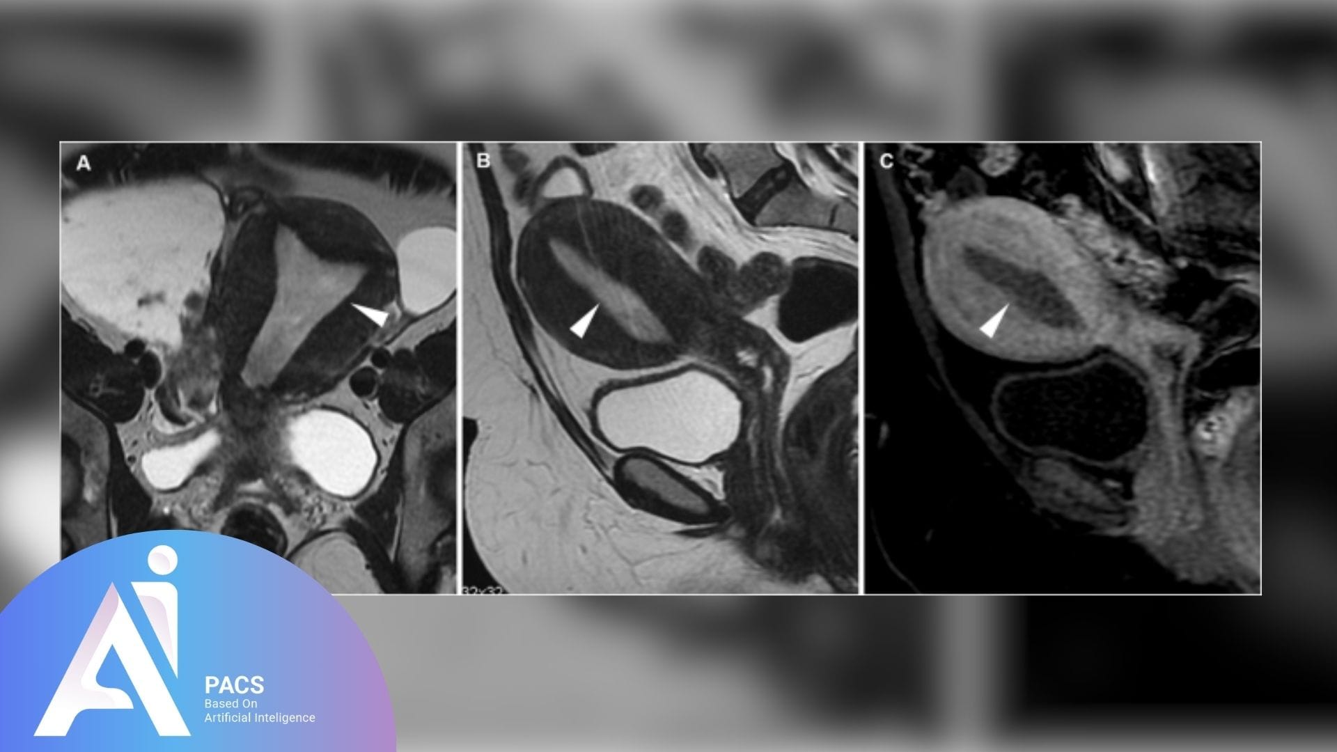 thick endumetrium causes Abnormal Uterine Bleeding (AUB) MRI