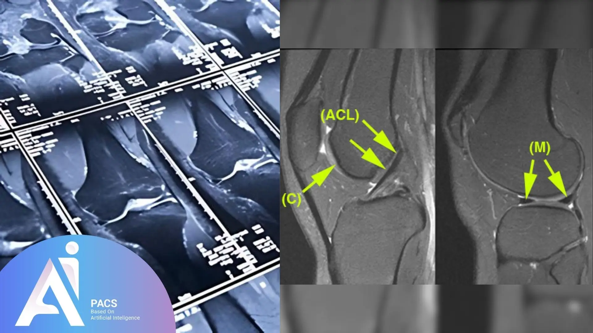 A detailed view of knee MRI scans, highlighting the anterior cruciate ligament (ACL) and medial structures (M), with annotations pointing to key anatomical features.