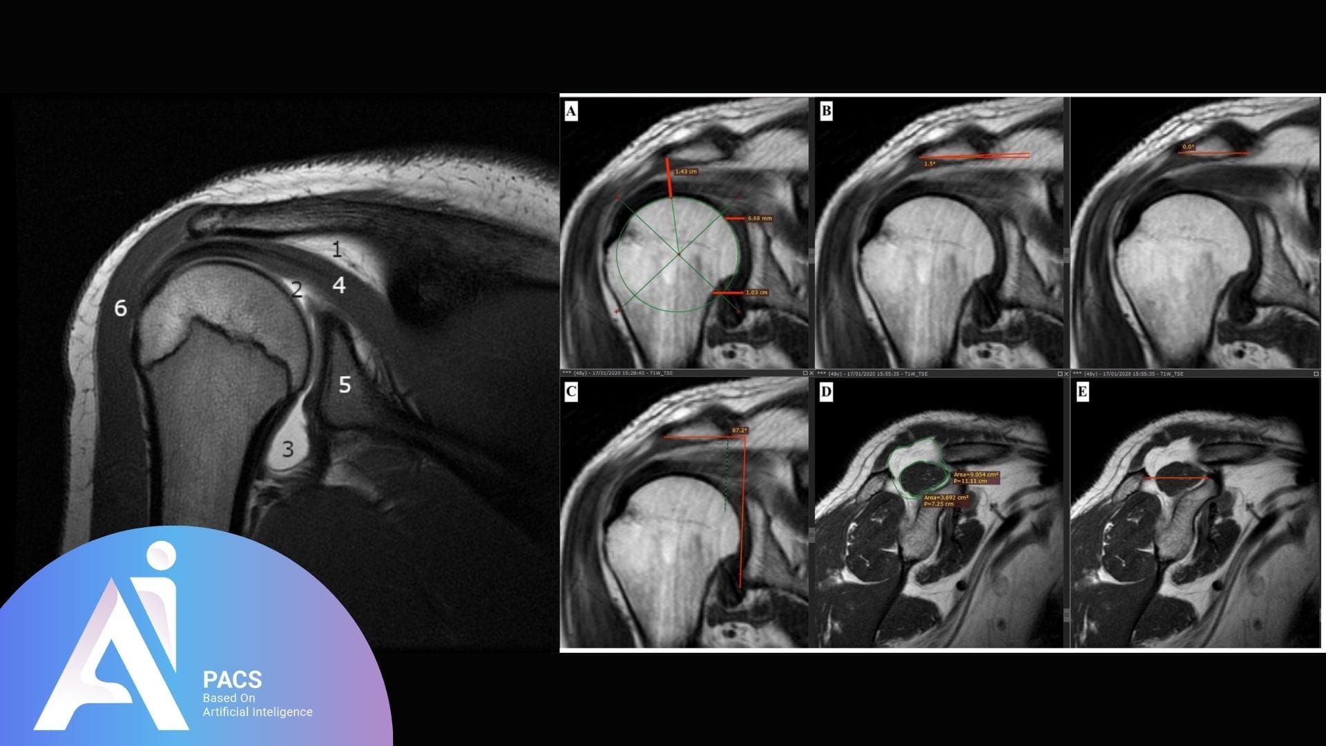 MRI showing detailed shoulder joint analysis with measurements of various anatomical structures for precise diagnostics.