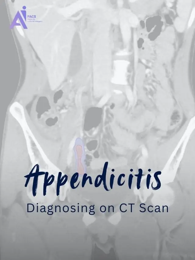 How CT Scans Aid in Diagnosing Appendicitis