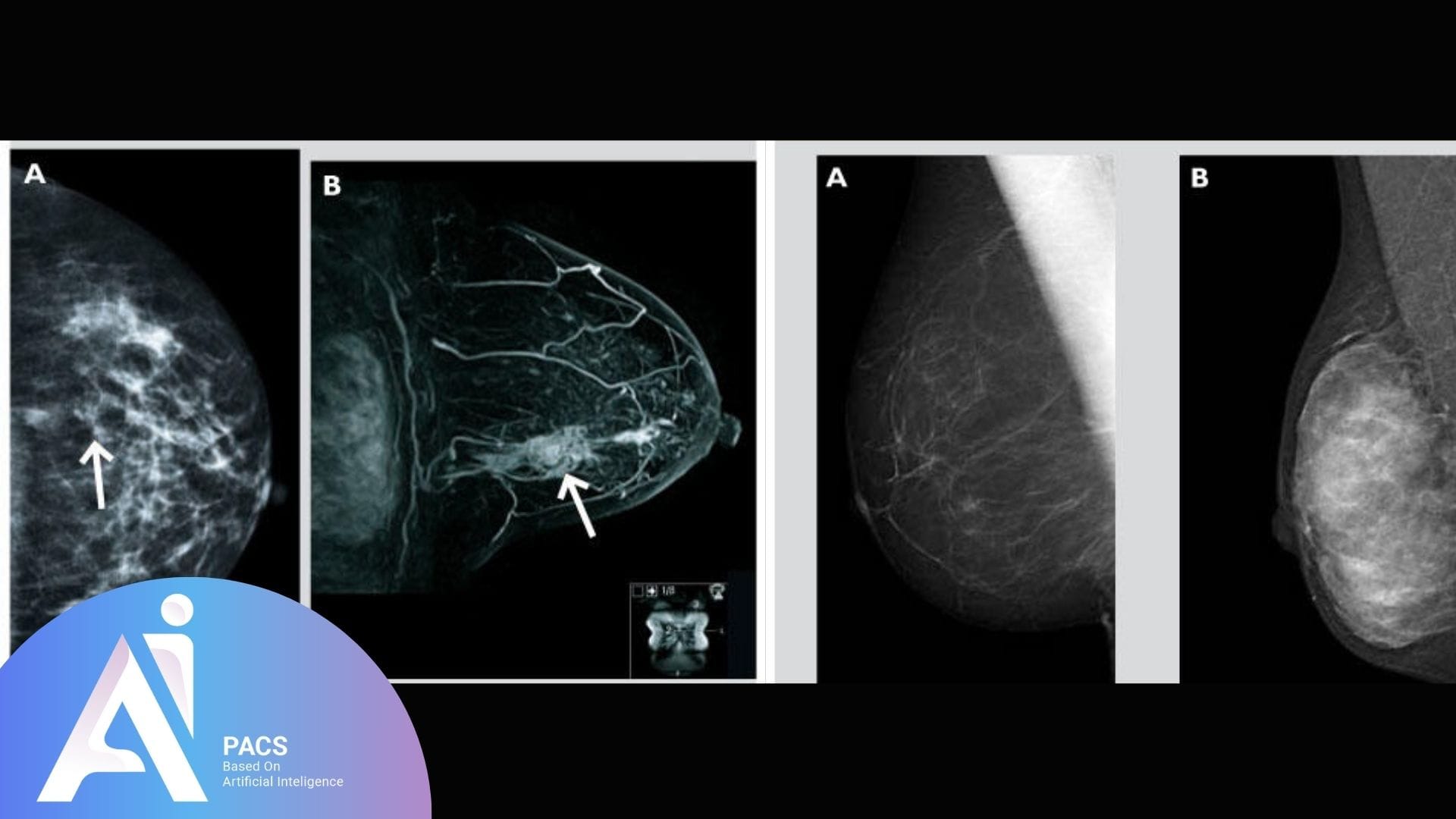 Imagerie de la mammographie et de l'IRM mammaire mettant en évidence une anomalie dans les tissus mammaires. Les flèches indiquent la localisation de la lésion, avec une analyse approfondie de l'extension locale de la tumeur. La comparaison des différentes techniques d'imagerie permet de mieux évaluer la propagation de la lésion dans le sein.