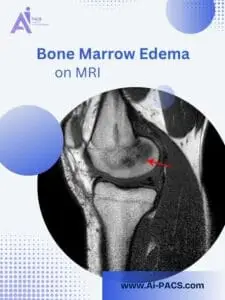 Bone Marrow Edema Overview