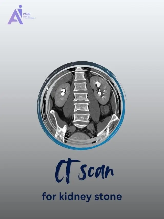 How CT Scans Detect Kidney Stones
