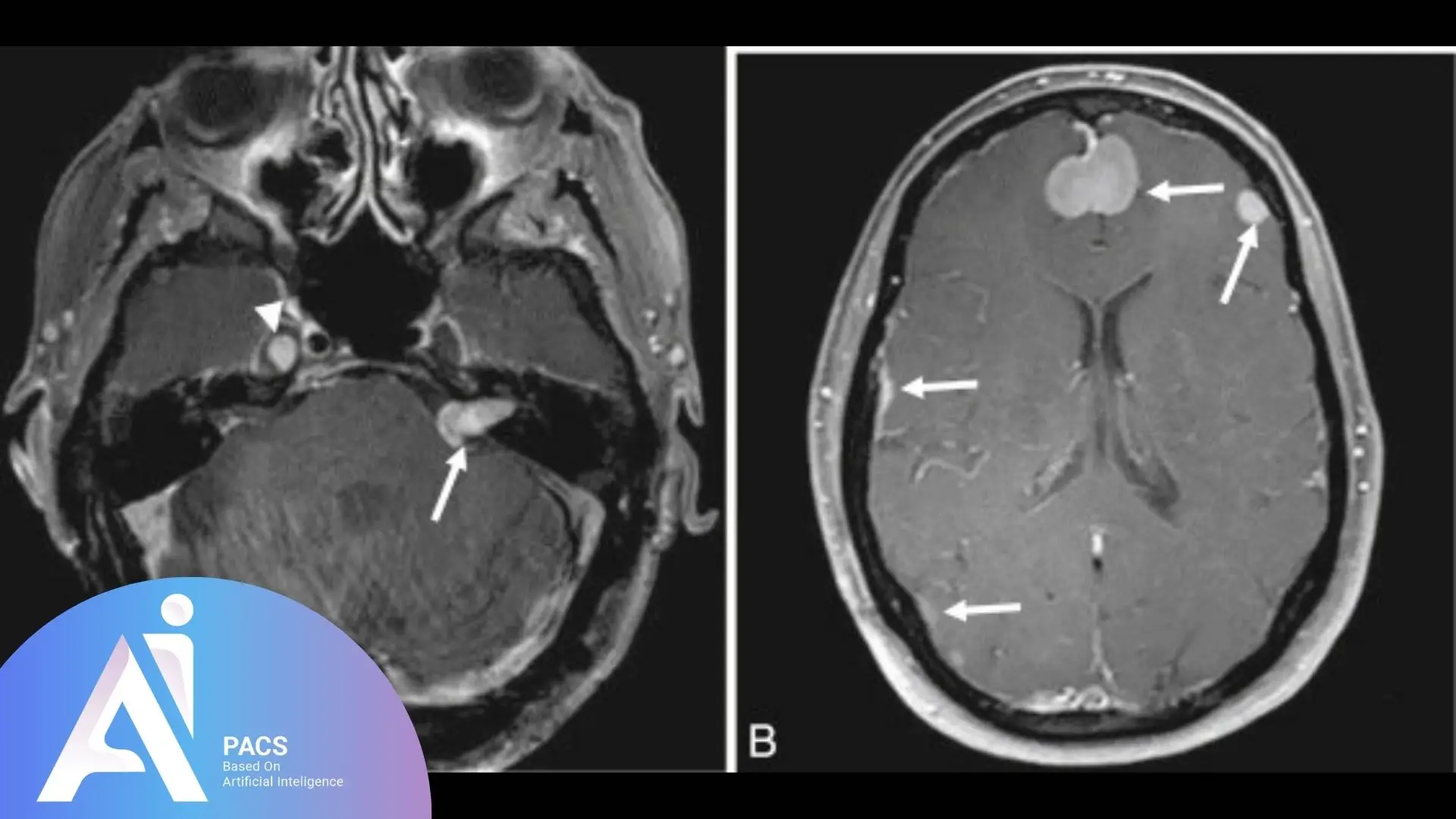 MRI images of the cerebellopontine angle (CPA) showing lesions. The first image on the left (A) shows a coronal section with arrows pointing to a lesion near the right CPA, while the second image on the right (B) is a transverse section highlighting a similar lesion in the left CPA. Both images show the clear delineation of the lesions using white arrows.