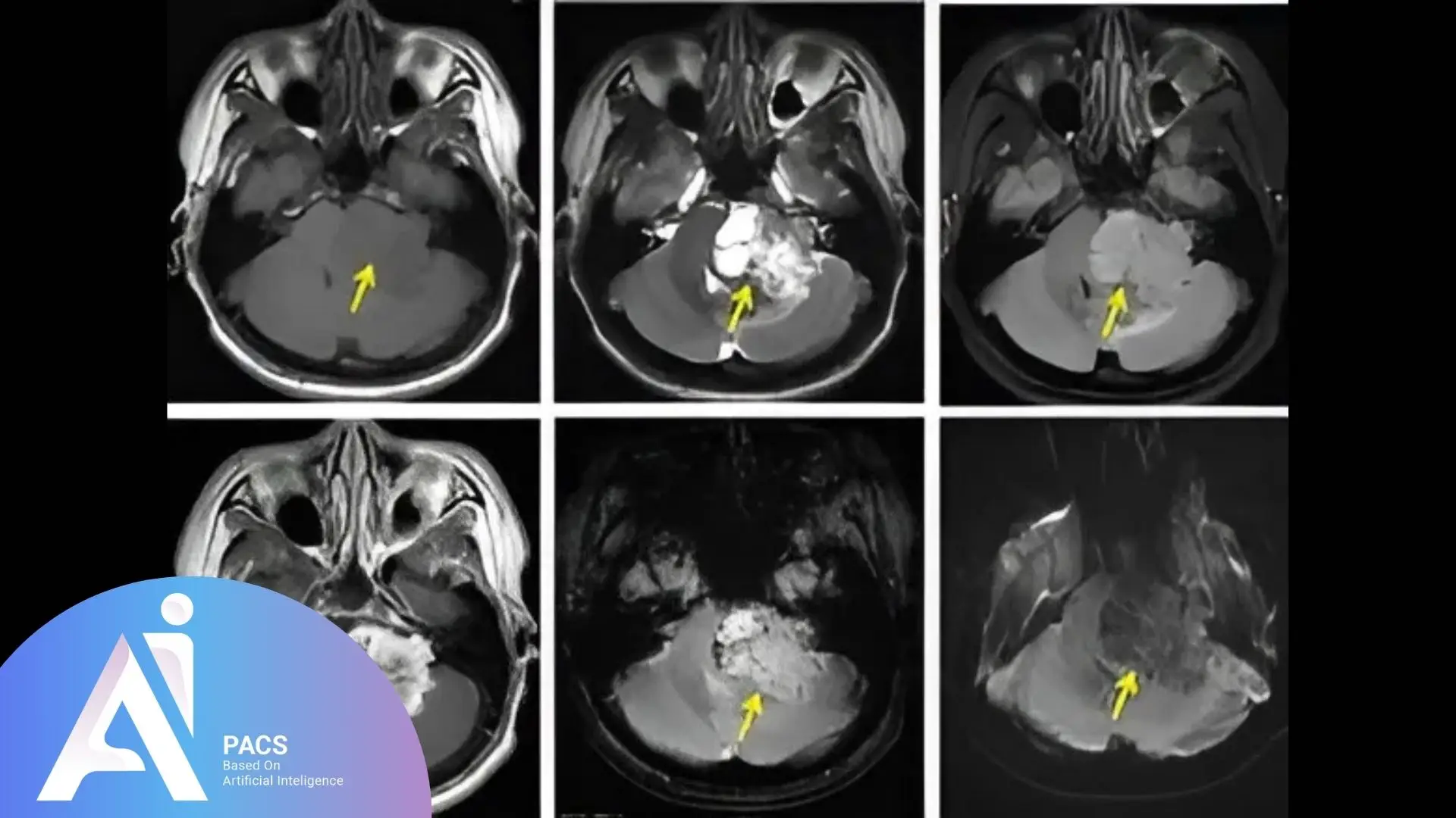 MRI images of a cerebellopontine angle tumor across different planes (axial, coronal, and sagittal). The images show a mass (highlighted by yellow arrows) that has characteristics typical of a CPA tumor, with varying intensity on different MRI sequences, indicative of the lesion's composition and location.