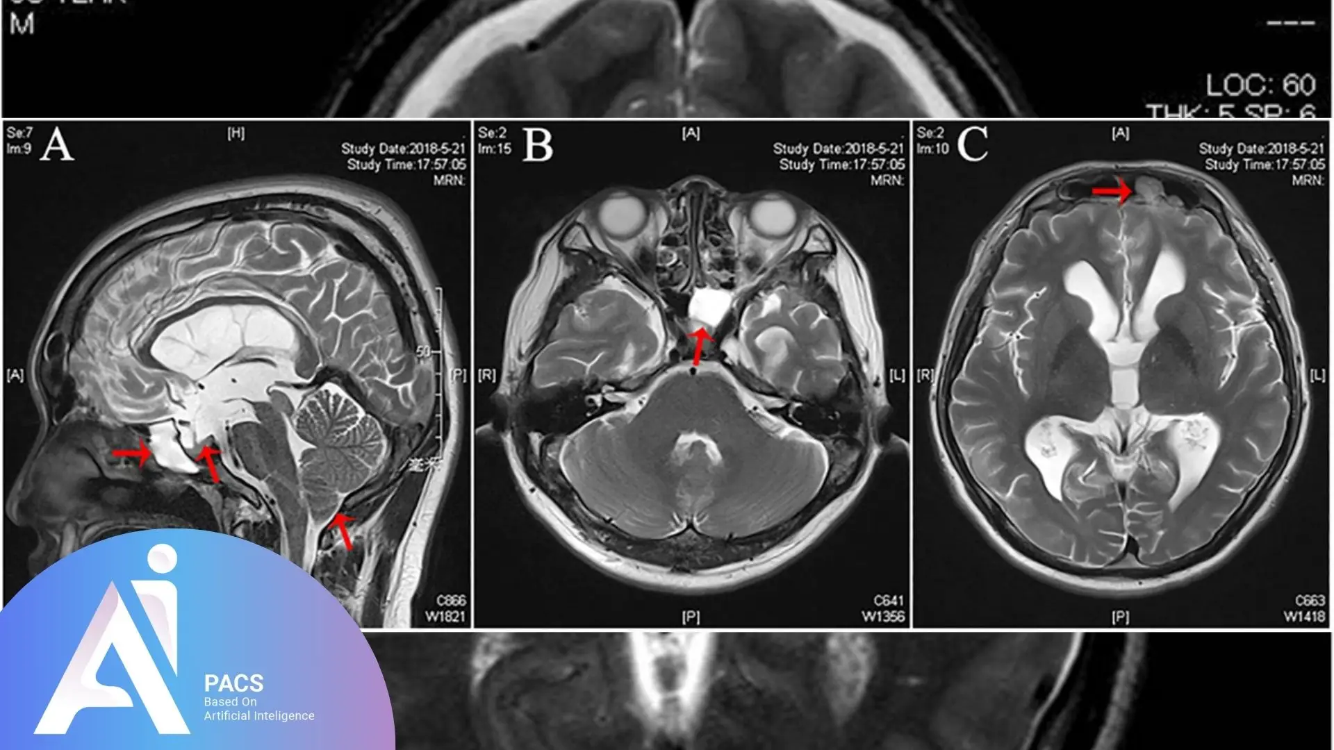 MRI brain scans in sagittal, axial, and coronal views with red arrows highlighting areas of suspected cerebrospinal fluid (CSF) leakage.