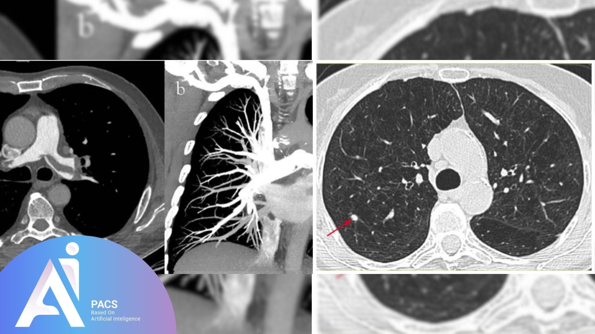 L'image montre plusieurs sections de scanner thoracique, mettant en évidence des vues détaillées des poumons, des vaisseaux pulmonaires et des anomalies éventuelles. Sur l'une des images, une flèche rouge indique une zone d'intérêt.
