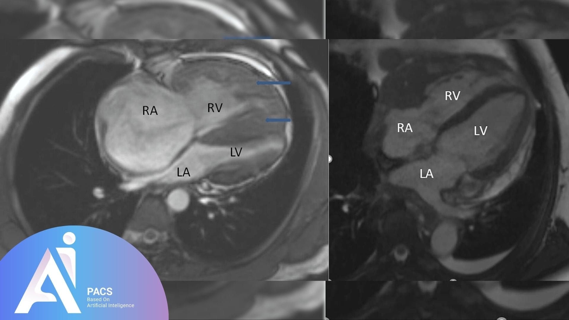 dynamic contrast MRI of the heart, highlighting the right and left atria (RA, LA), right and left ventricles (RV, LV), with clear indications of the cardiovascular structures.