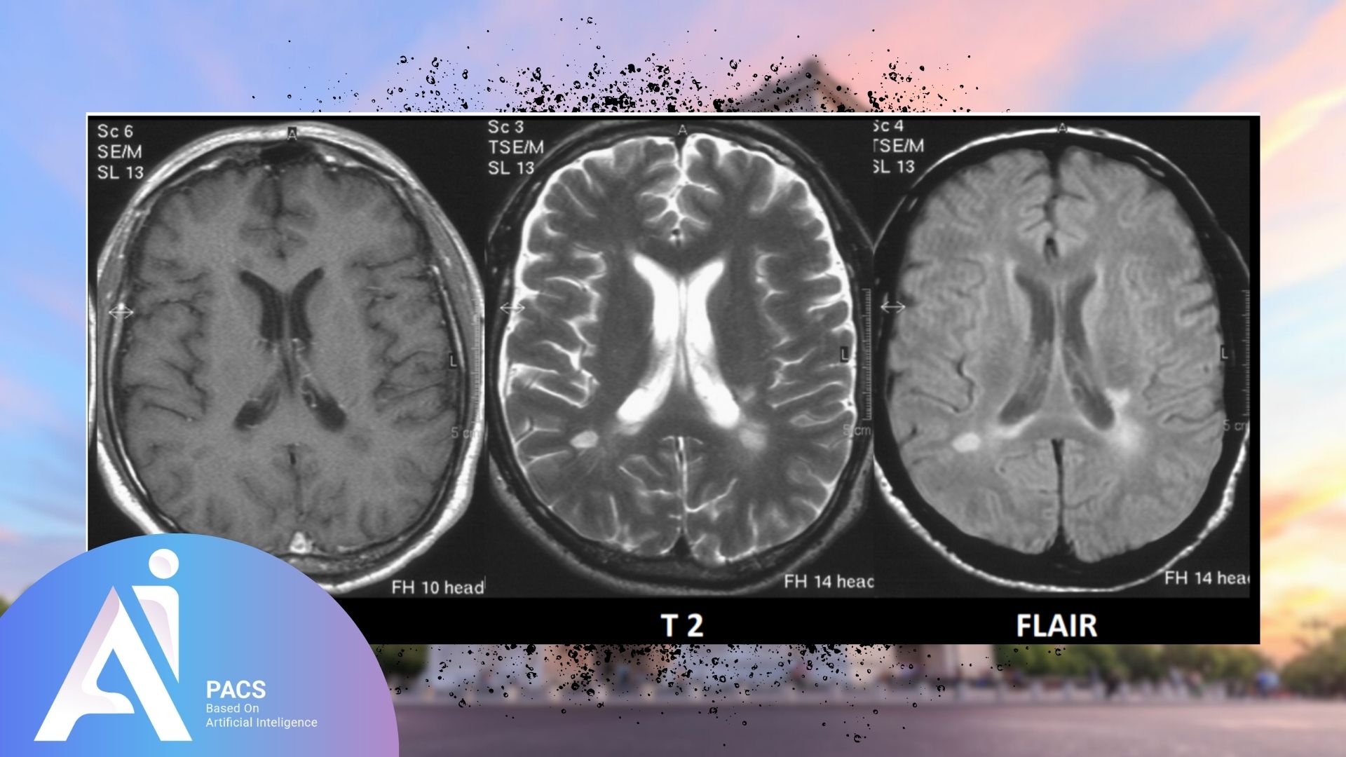 L'image montre une série de coupes IRM du cerveau, incluant des séquences SEM, T2 et FLAIR pour l'analyse de la sclérose en plaques.