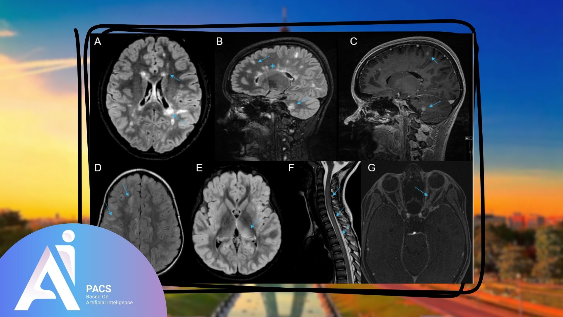L'image présente plusieurs vues IRM du cerveau et de la colonne vertébrale, mettant en évidence des lésions typiques de la sclérose en plaques.