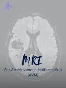 Early AVM Detection with MRI