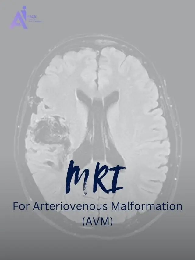 Early AVM Detection with MRI