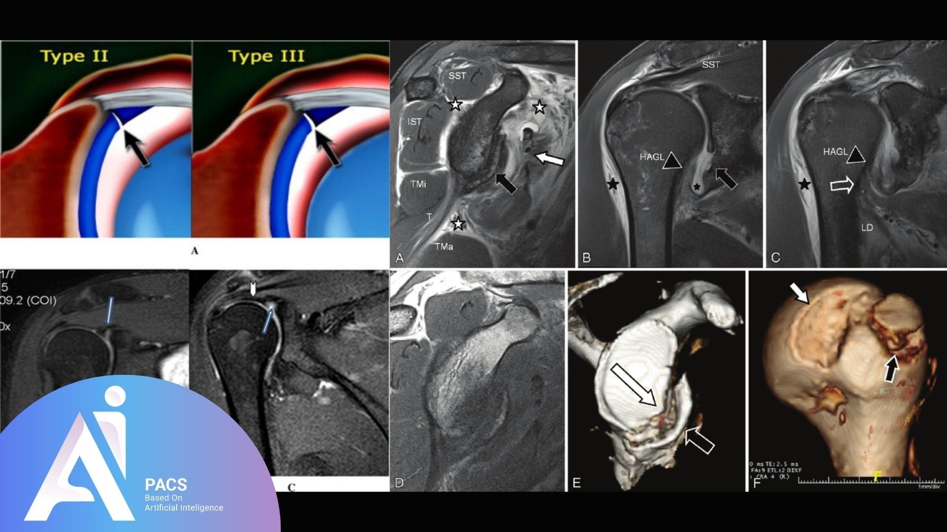 MRI and MR arthrography images of the shoulder joint highlighting various injuries and abnormalities in athletes with shoulder dislocation.