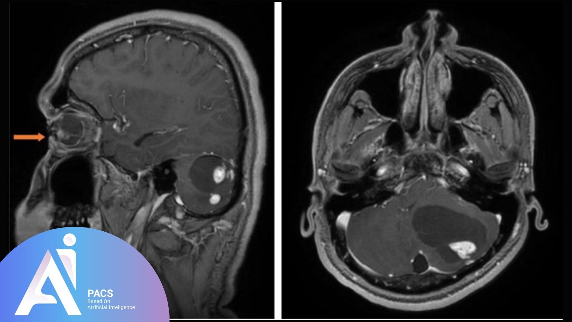a sagittal MRI scan highlighting a possible mass in the brain's posterior fossa, with the tumor indicated by an orange arrow.