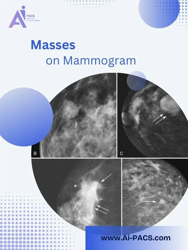 Understanding Breast Masses