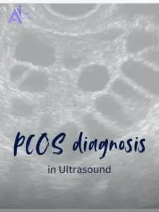 PCOS diagnosis in Ultrasound