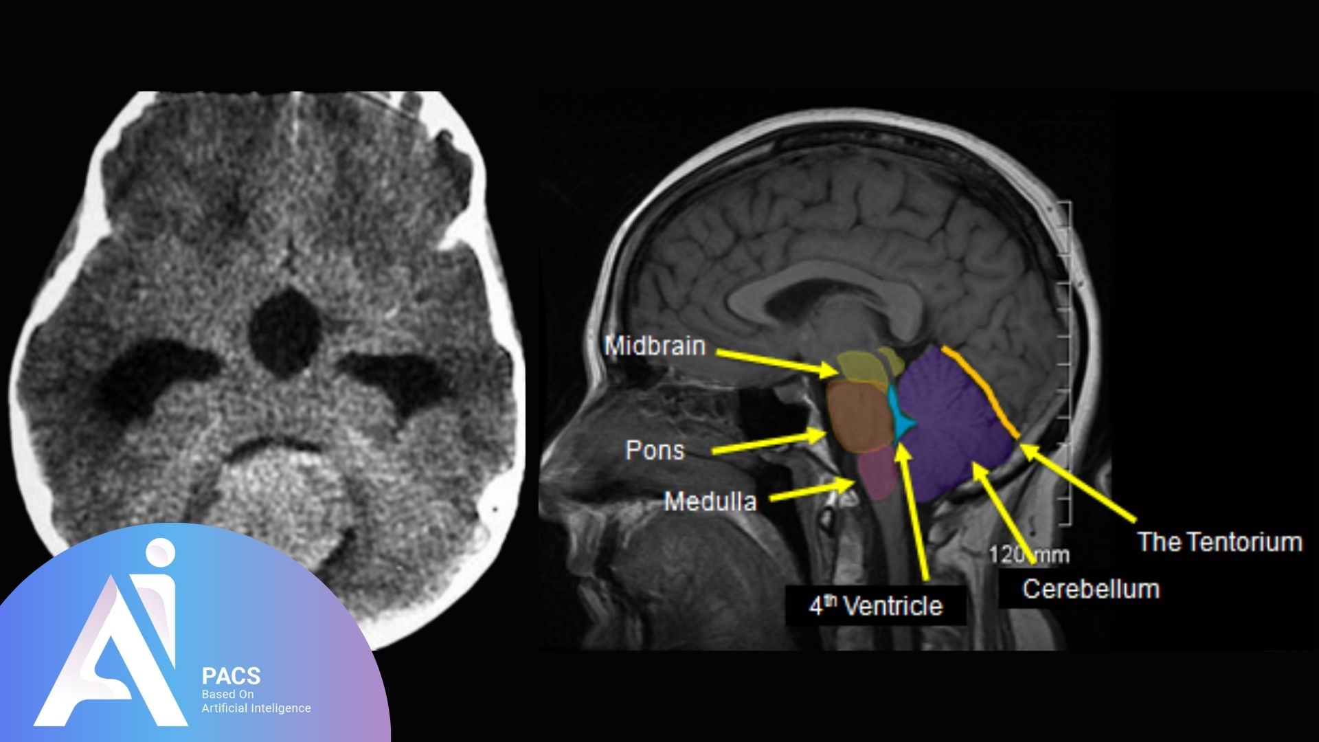 a CT scan and a labeled MRI of the brain's posterior fossa, detailing key anatomical structures like the midbrain, pons, medulla, and cerebellum.