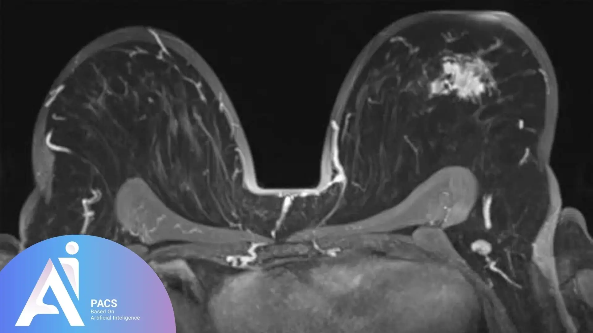 Understanding Breast MRI for cancer screening