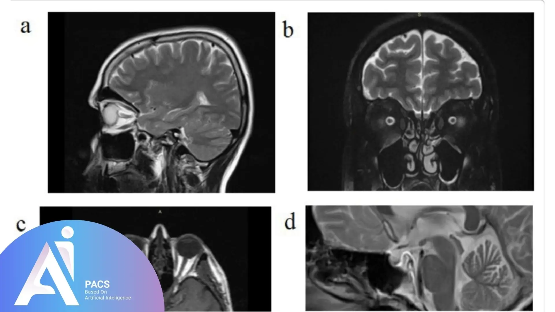 brain scans showing different perspectives: sagittal, coronal, and axial views (a, b, c, d) – Essential for evaluating various neurological conditions, including intracranial pressure.