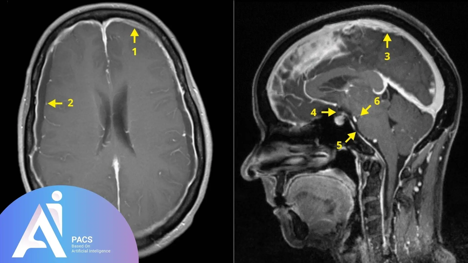 MRI brain scans (axial and sagittal views) with yellow arrows marking abnormal findings suggestive of a cerebrospinal fluid (CSF) leak.