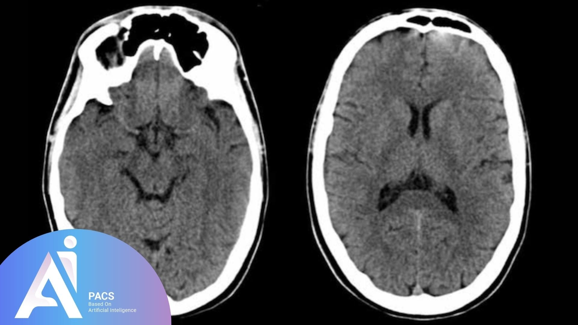 scan of the brain displaying a cross-sectional view – Crucial for diagnosing conditions such as increased intracranial pressure and other brain abnormalities.