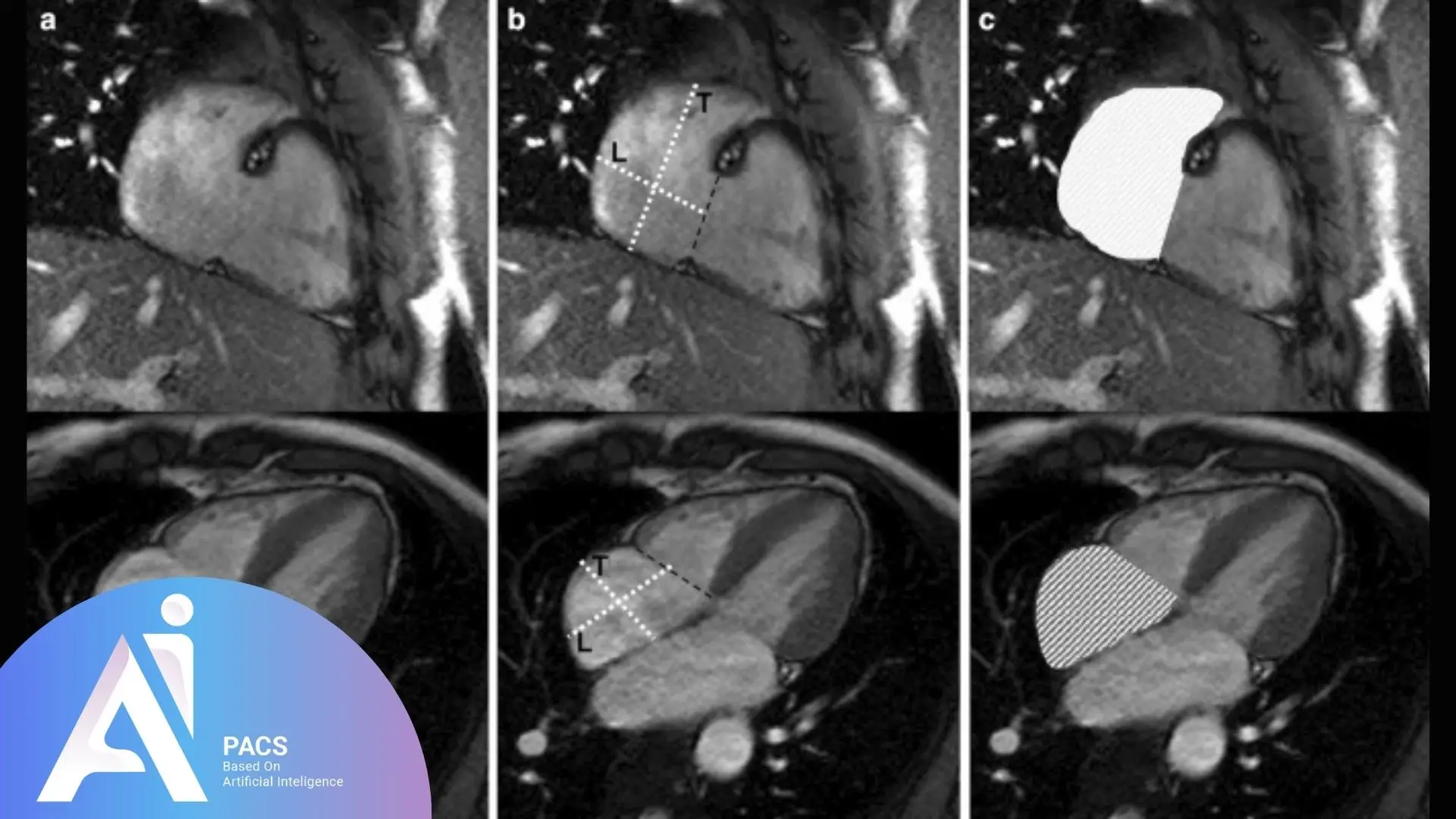 he four-chamber MRI view of the heart, with outlined measurements and segmentation of the heart's left and right ventricles (L, RV), and the myocardium.