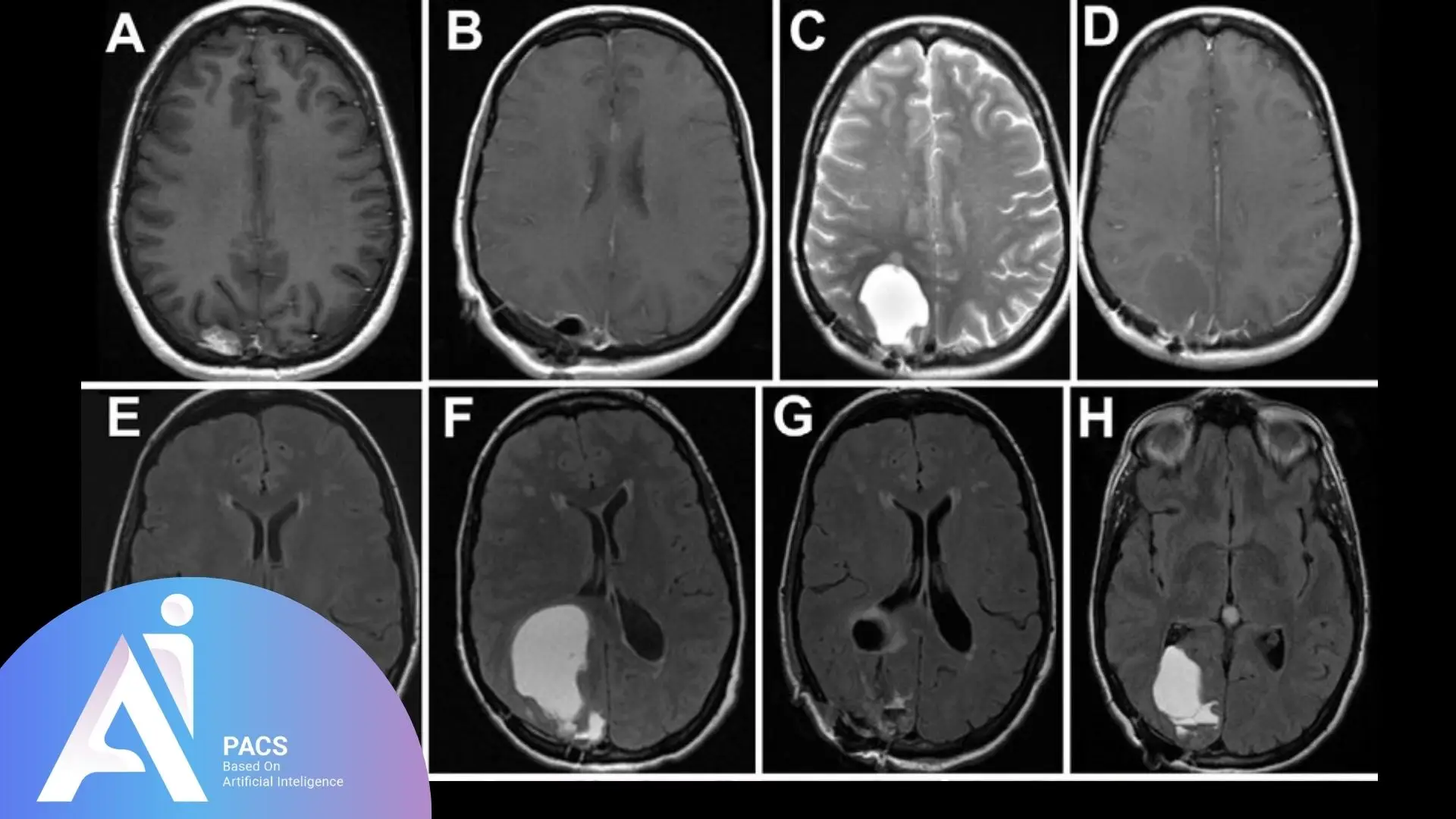 presents a series of MRI brain scans in various planes, demonstrating a lesion with different contrast characteristics across different sequences.