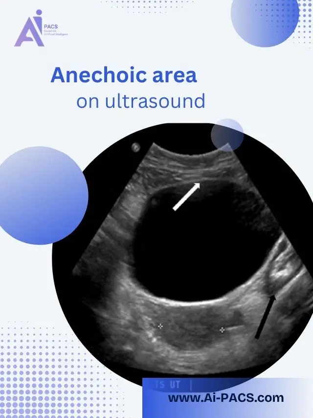Anechoic Findings on Ultrasound