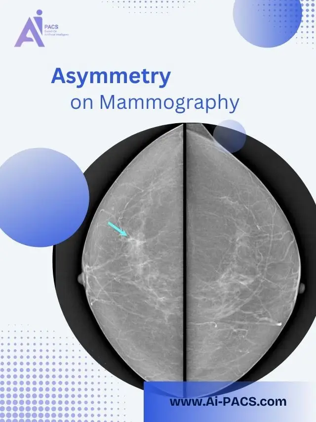 Understanding Mammogram Asymmetry