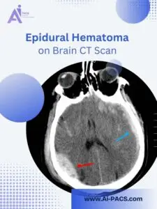 EDH on Brain CT Scan