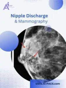 Nipple Discharge and Mammography Explained