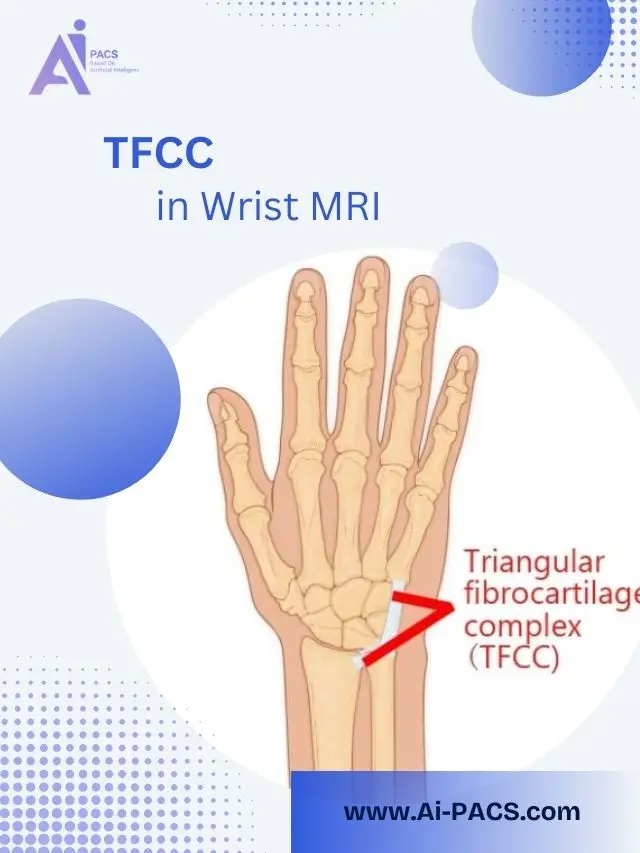 TFCC in Wrist MRI
