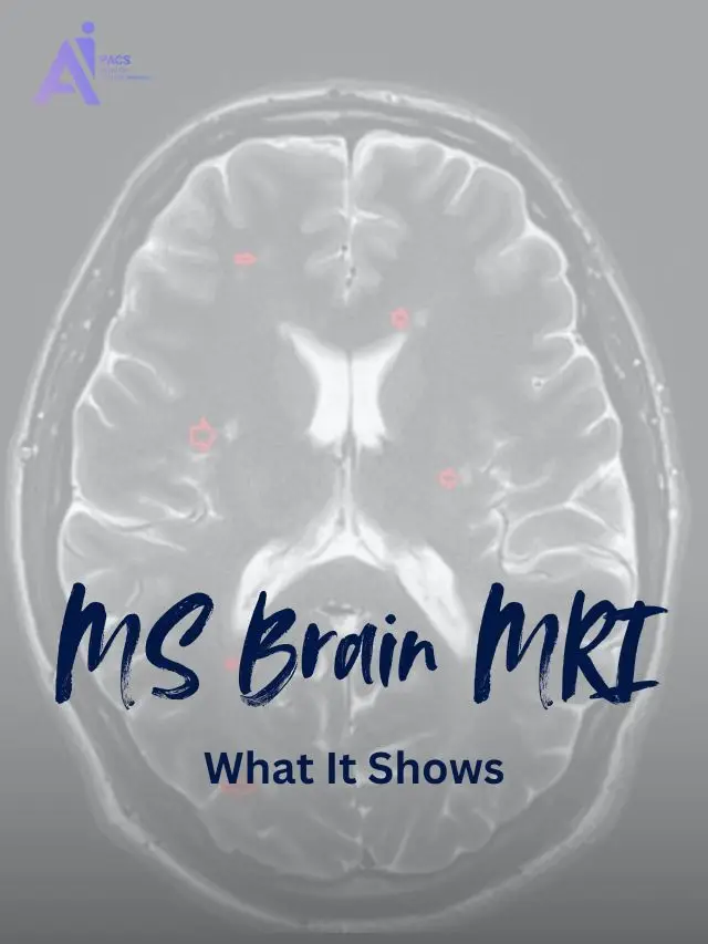 How MRI Reveals MS Activity in the Brain