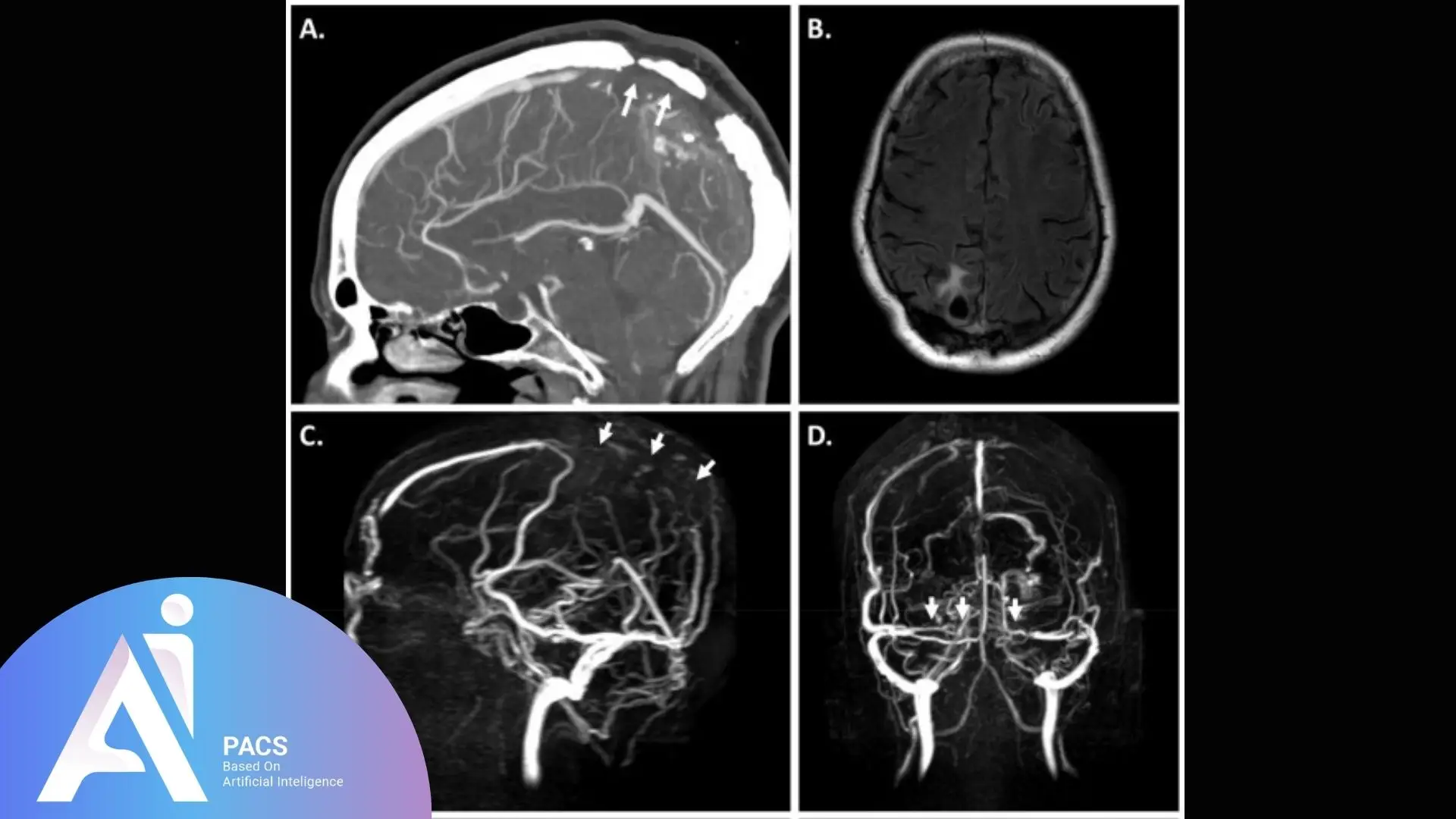 Magnetic resonance thrombus imaging.
