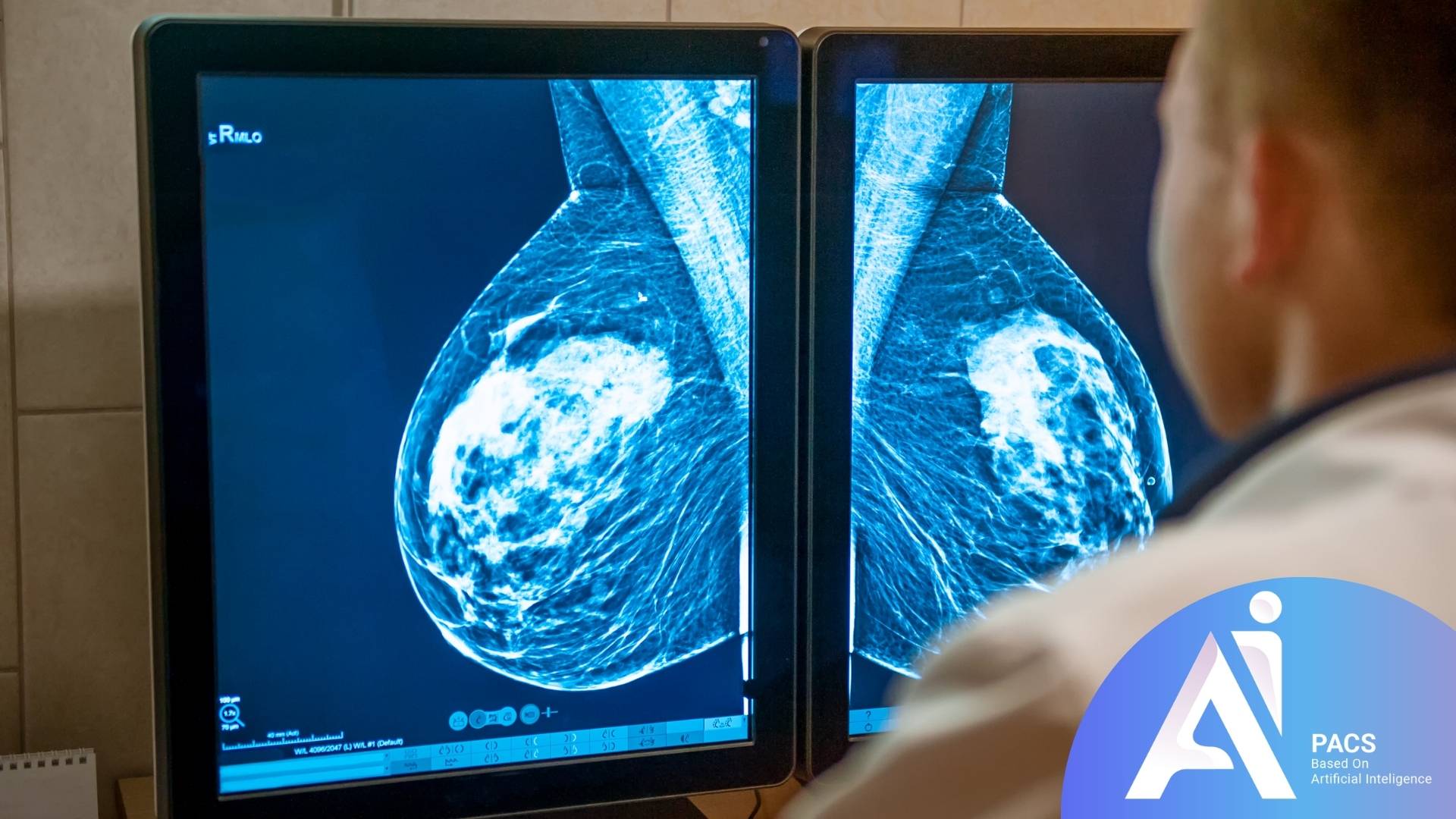 Large Bright White Spot on Mammogram